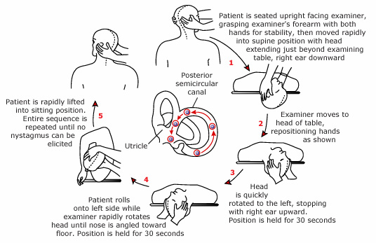 hallpike maneuver illustration